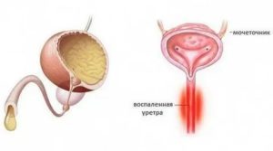 Чешется уретра после антибиотиков