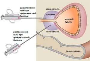 Чем опасно делать биопсию простаты