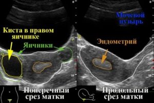 Когда делать узи кисты яичника если нет месячных