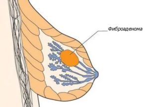 Что такое аденома и киста молочной железы