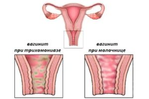 Как отличить молочницу от кольпита