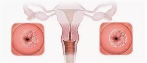 Может ли быть задержка месячных после эрозии шейки матки прижиганием