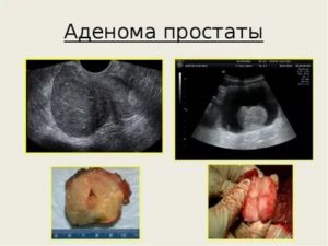 Диагноз предстательная железа susp