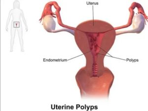 Чем отличаются полипы от кист матки