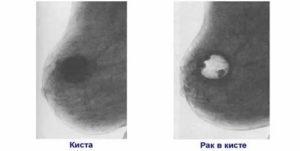 Что делать если лопнула киста в молочной железе
