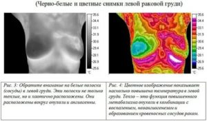 Термография при раке молочной железы