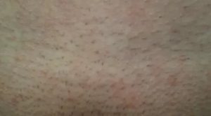 Мазь красные пятна на лобке