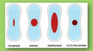 Как уменьшить обильность месячных в домашних условиях