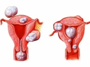 Опухоль на матке психологические причины