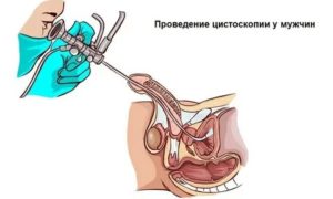 Обструкция уретры диагностика