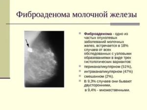 Можно ли принимать дюфастон при фиброаденоме молочной железы