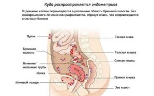Эндометриоз боль при ней может отдавать в ногу