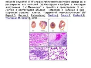 Некроз опухоли шейки матки