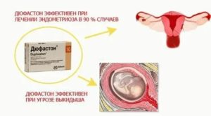 Дюфастон как принимать при эндометриозе время в время