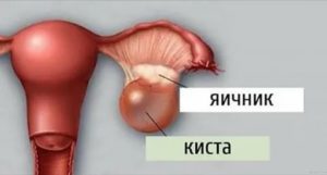 Что такое функциональная киста яичника и как ее вылечить