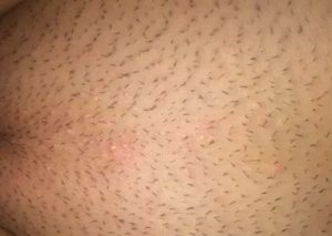 После бритья интимной зоны появляется молочница