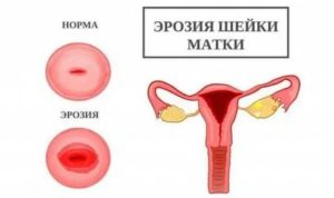 Крем тенториум эрозия шейки матки