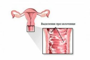 Может ли молочница передаваться от мамы к ребенку