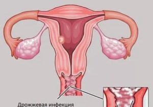 Что делать молочница появляется после каждых месячных