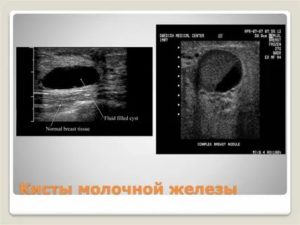 Что такое киста молочной железы с пристеночным компонентом