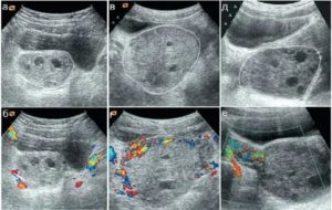 Образование повышенной эхогенности в яичнике что это такое на узи