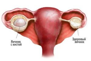 Может ли при кисте желтого тела быть коричневые выделения
