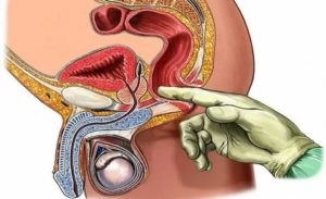 Должны ли быть боли при массаже предстательной железы