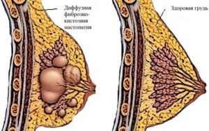 Как часто фиброзно-кистозная мастопатия переходит в рак