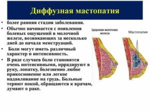 Как часто фиброзно-кистозная мастопатия переходит в рак