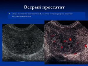 Фиброзные изменения предстательной железы что это такое лечение