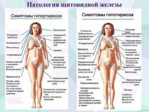 Могут ли быть проблемы с месячными из за щитовидной железы