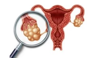 Когда нужно делать операцию если есть поликистоз яичников