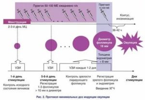 Узи контроль при стимуляции овуляции