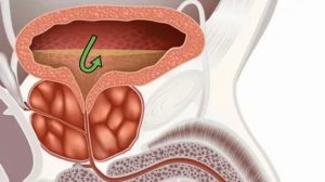 Что такое везикулостаз предстательной железы
