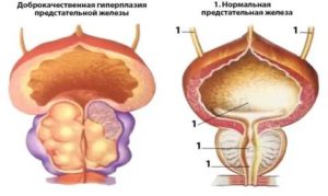 Дисплазия предстательной железы что это такое