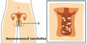 Молочница 33 неделя лечить или нет