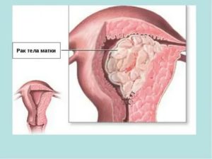 Причины рака матки эзотерика