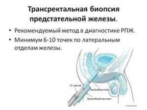 Биопсия предстательной железы тур-биопсия предстательной железы