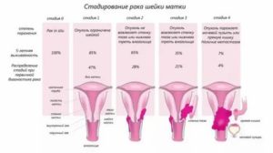 Рак шейки матки и беременность клинические рекомендации