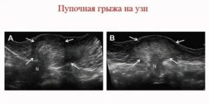 Покажет ли узи паховую грыжу у ребенка