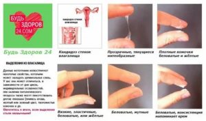 Может ли новаринг вызвать молочницу