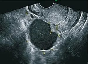 Солидная опухоль яичника на узи