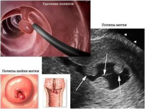 Как принимать дюфастон после удаления полипа эндометрия