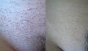 После бритья интимной зоны появляется молочница