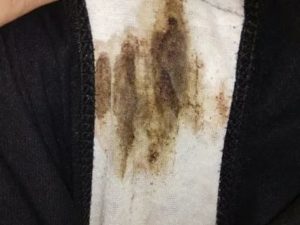 Что может означать когда перед месячными черные выделения