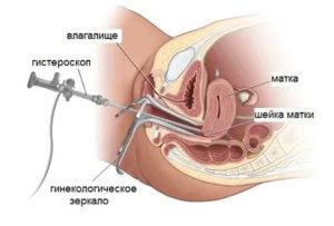 Гистероскопия матки при кровотечении