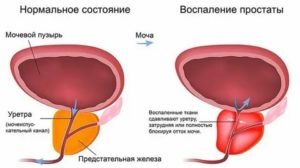 Аденома предстательной железы можно ли греть