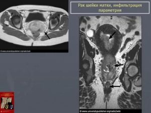 Опухоль с инфильтрацией параметрия