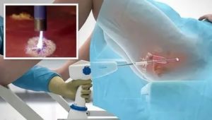 Как прижигают кисты шейки матки что это такое