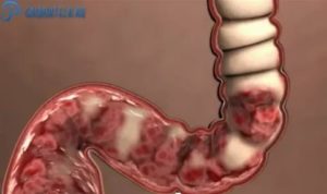 У меня была молочница может ли это вызывать запоры